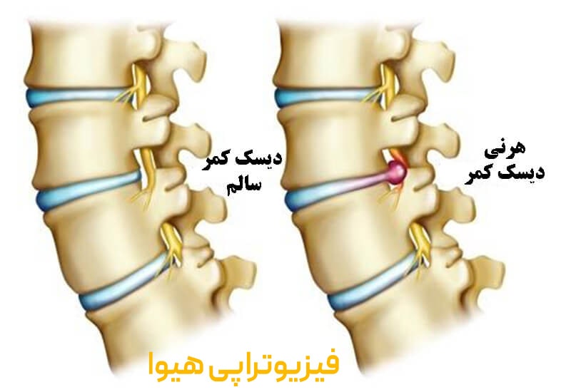 علائم و نشانه های دیسک پاراسنترال