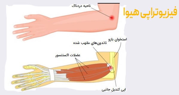 علائم پارگی تاندون دست چیست؟