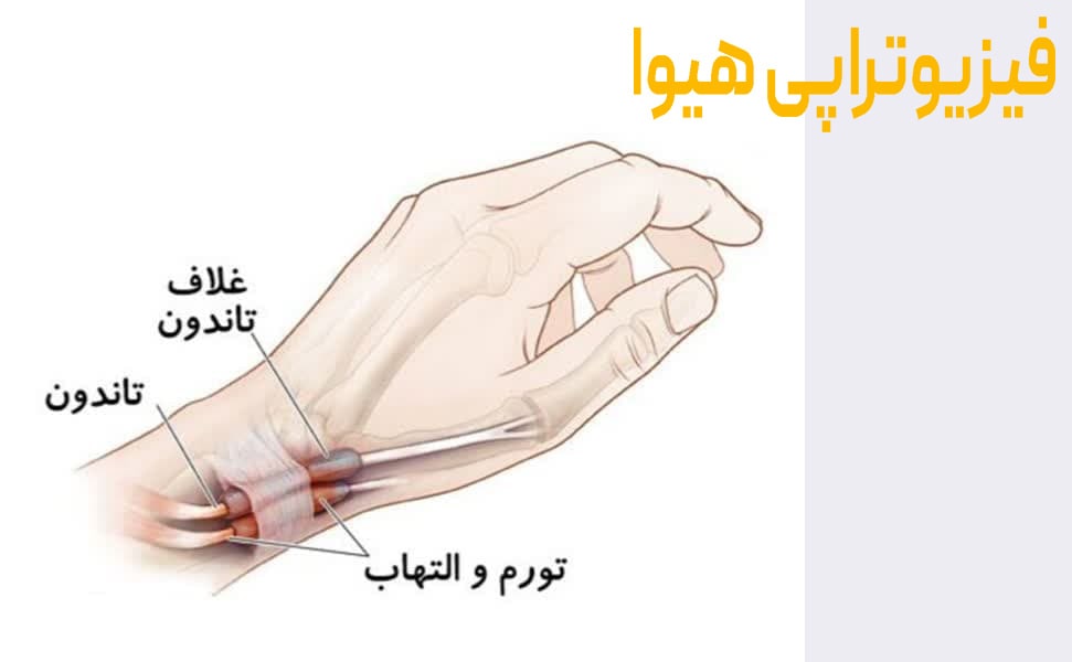 تاندون دست چیست؟ شناخت کامل ساختار و عملکرد تاندون های دست