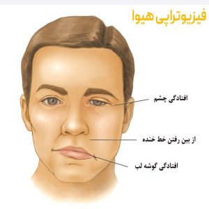 نقش فیزیوتراپی صورت در بهبود فلج عصب صورت