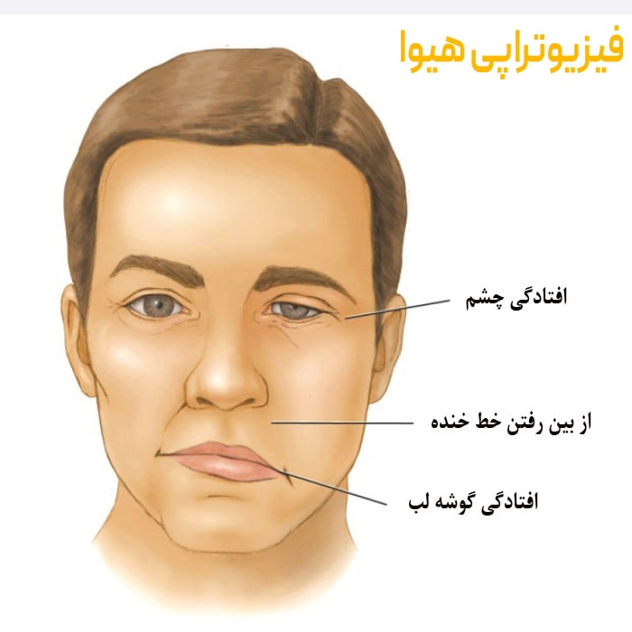 نقش فیزیوتراپی صورت در بهبود فلج عصب صورت