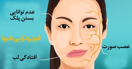دلایل و علائم فلج عصب صورت