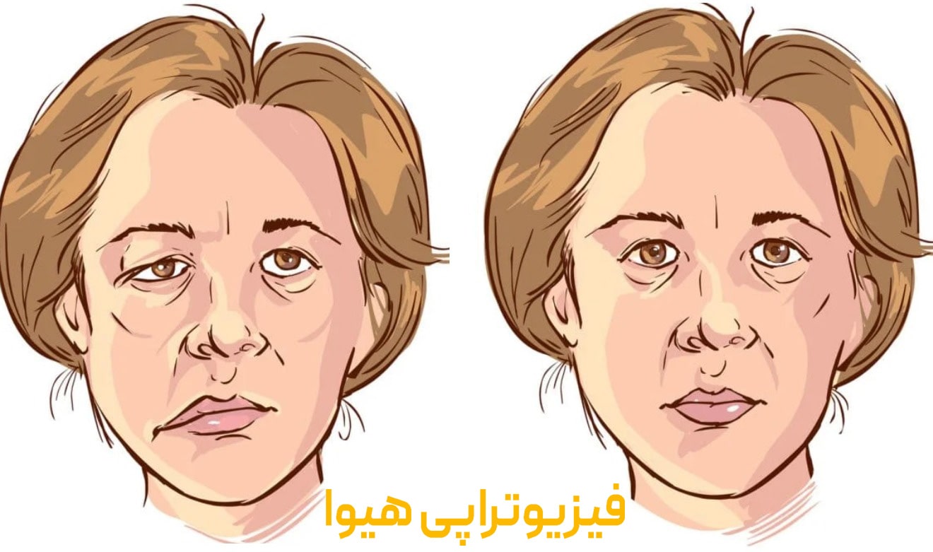 نقش فیزیوتراپی صورت در بهبود فلج عصب صورتی