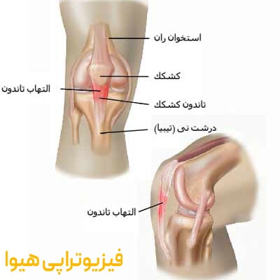 پارگی تاندون زانو چیست و چگونه درمان می‌شود؟
