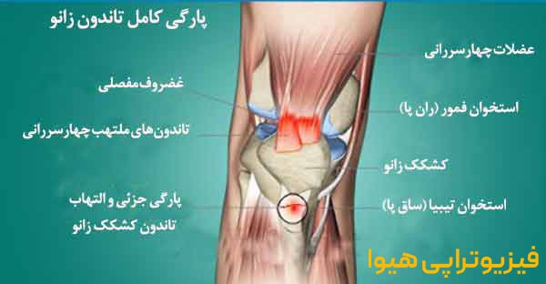 پارگی تاندون زانو چیست و علائم آن