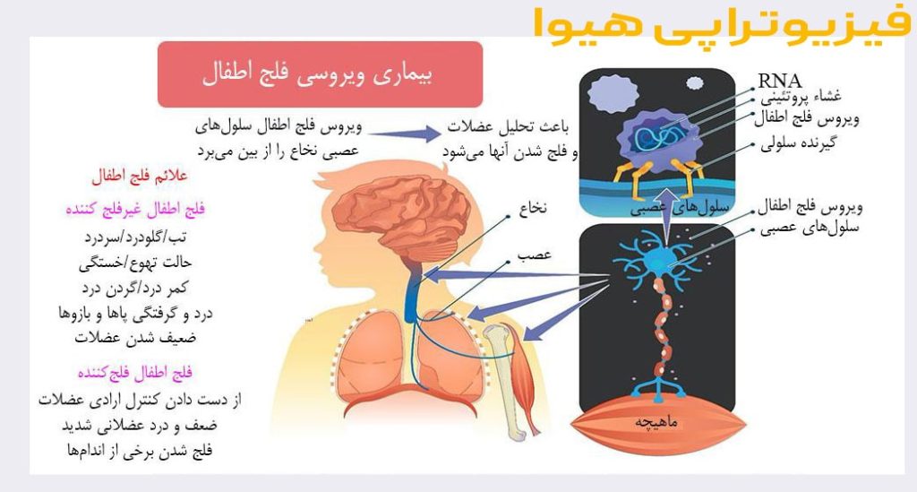 فلج اطفال