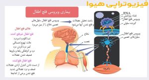 فلج اطفال