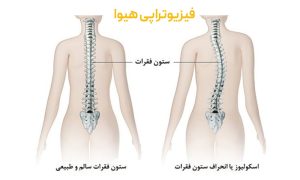 درمان انحراف ستون فقرات