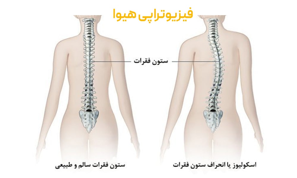 درمان انحراف ستون فقرات