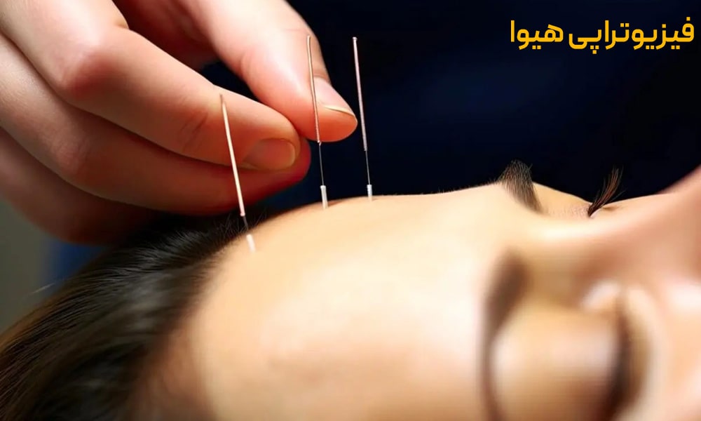 طب سوزنی چیست؟