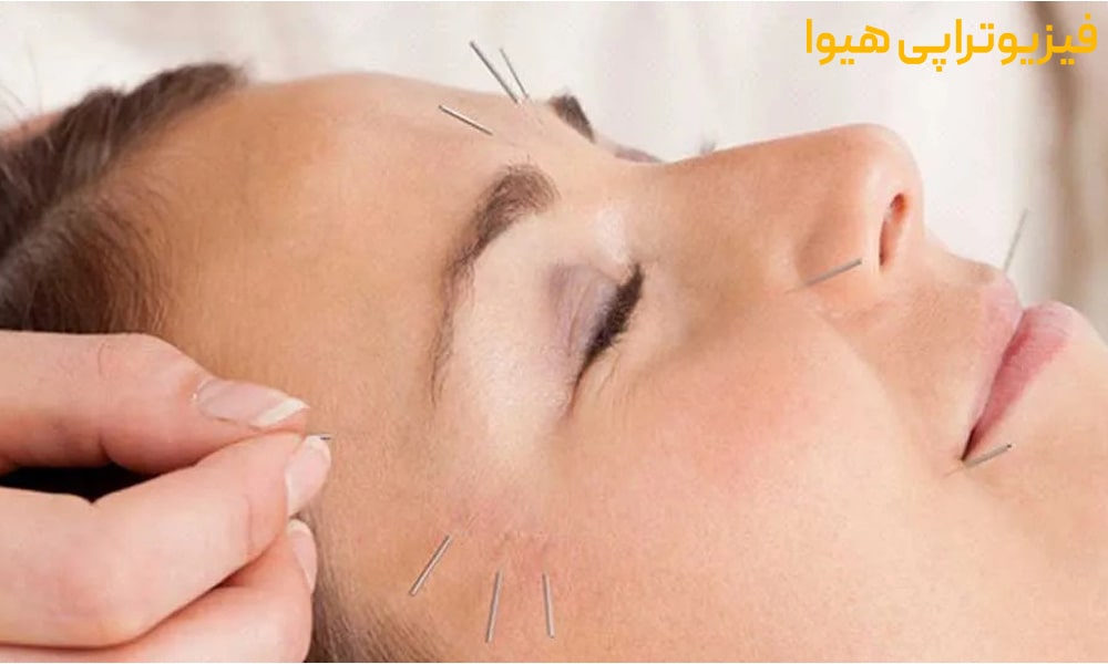 طب سوزنی چیست؟