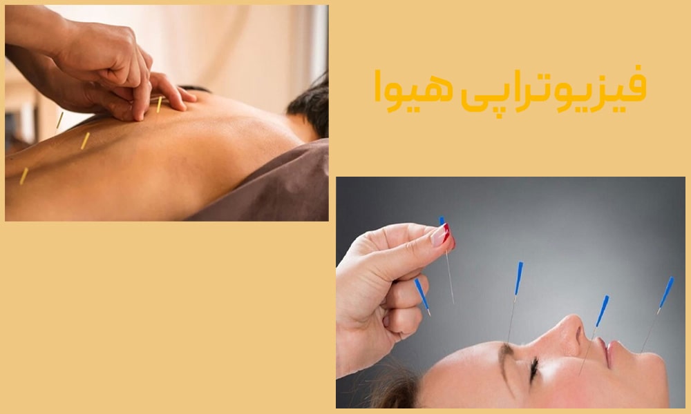 طب سوزنی چیست؟