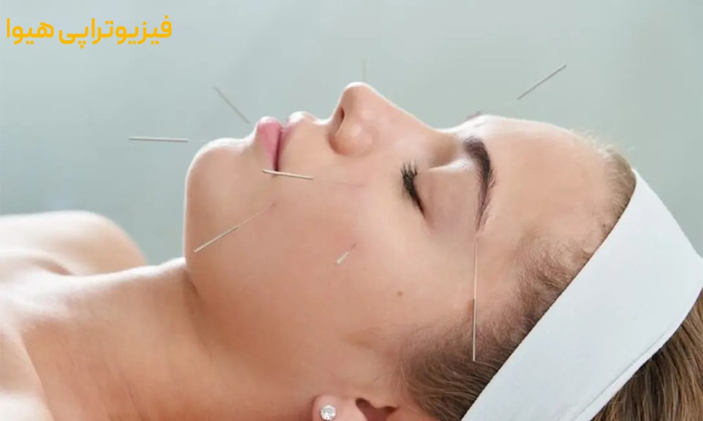 طب سوزنی چیست؟