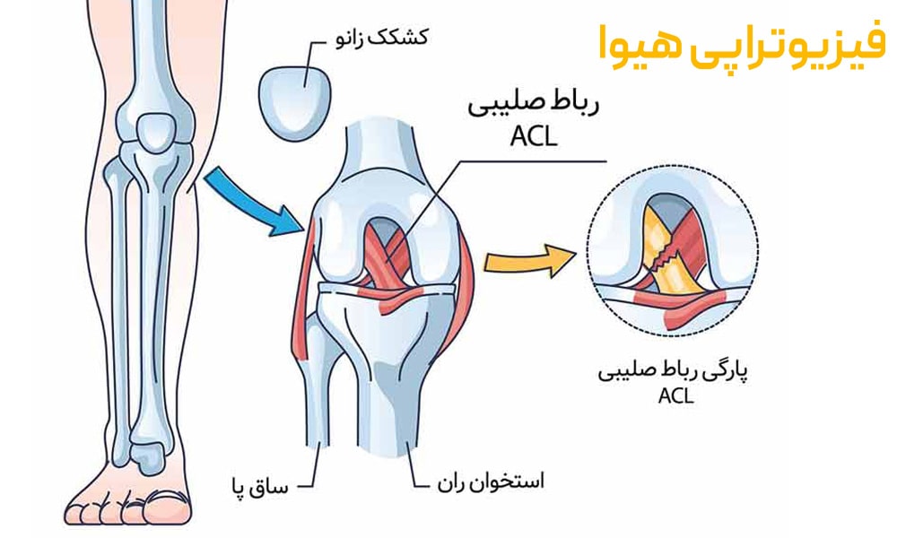 پارگی رباط زانو
