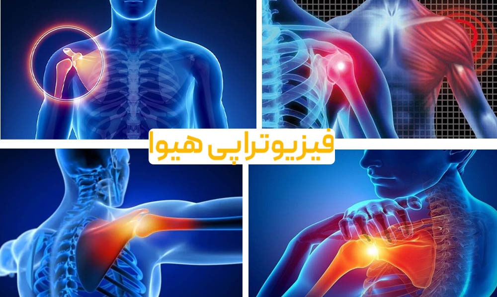 التهاب تاندون شانه چیست؟ علائم و درمان