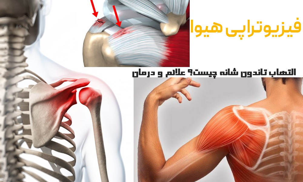 التهاب تاندون شانه چیست؟ علائم و درمان