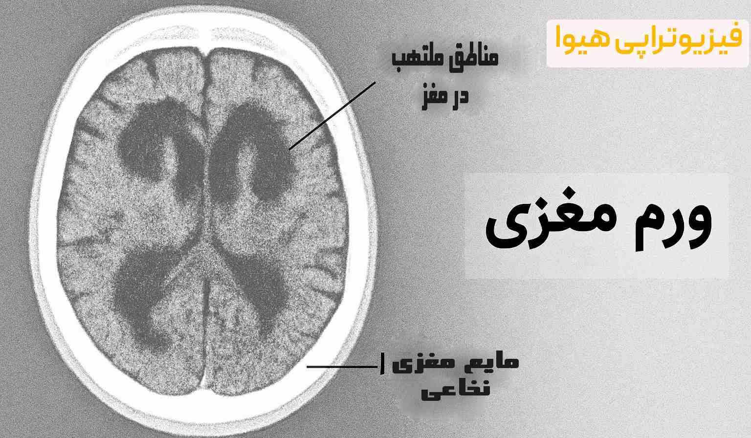 بیماری ورم مغزی