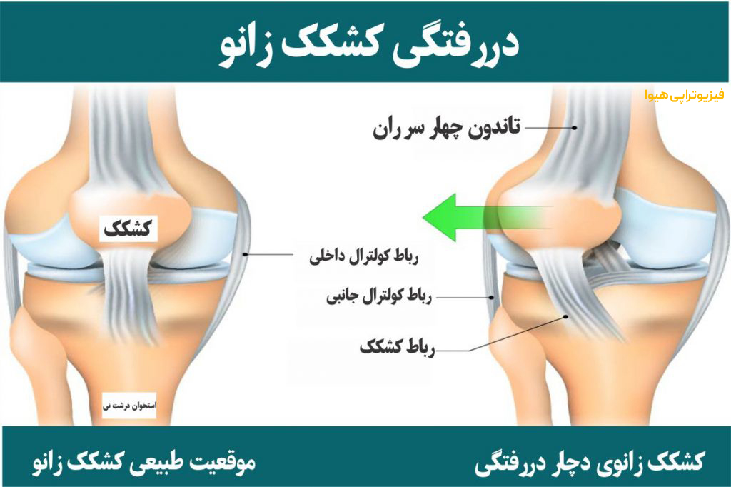 دررفتگی مادرزادی کشکک