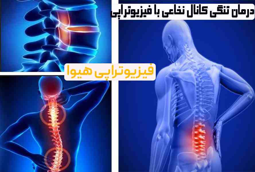 درمان تنگی کانال نخاعی با فیزیوتراپی 