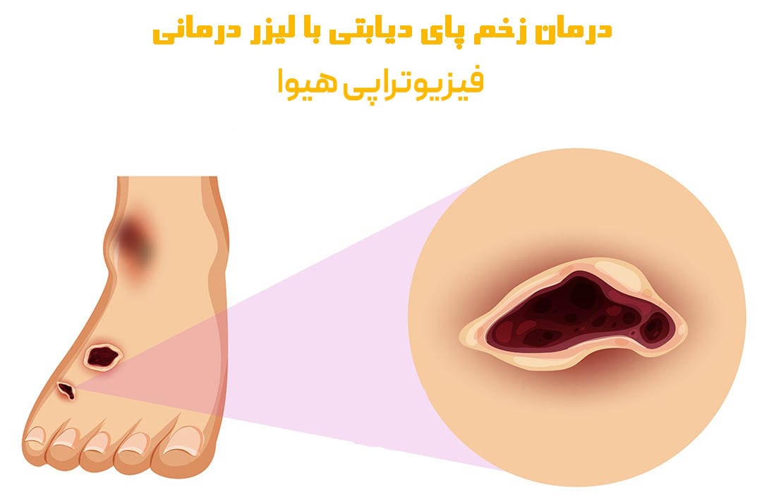 درمان زخم پای دیابتی با لیزر درمانی