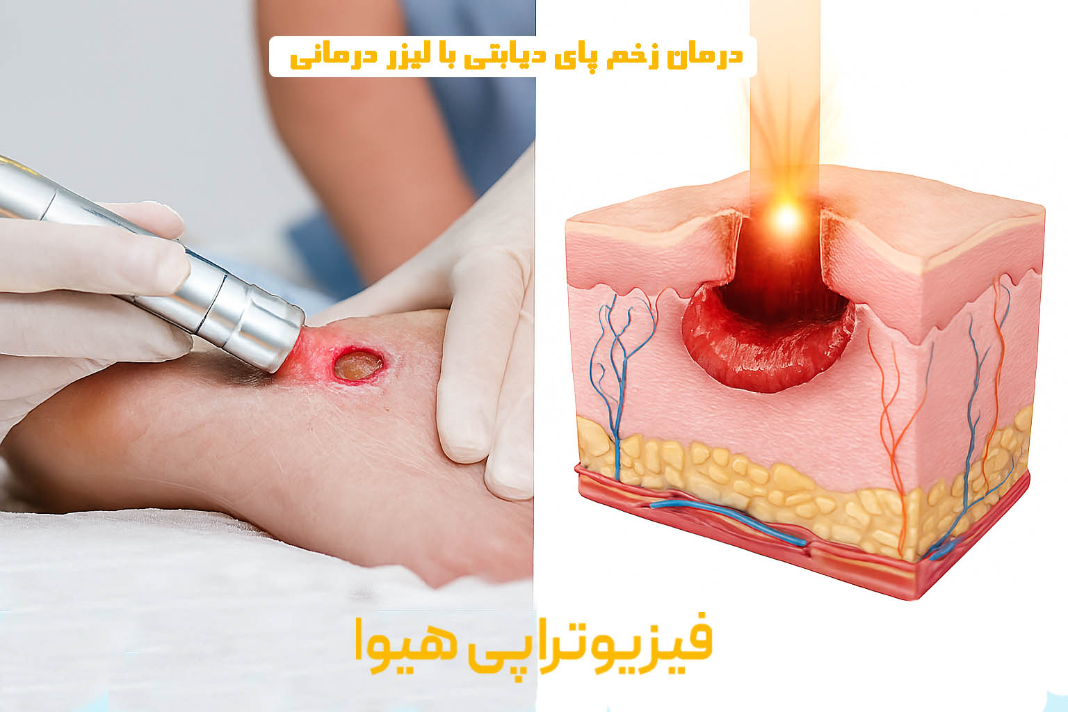درمان زخم پای دیابتی با لیزر درمانی