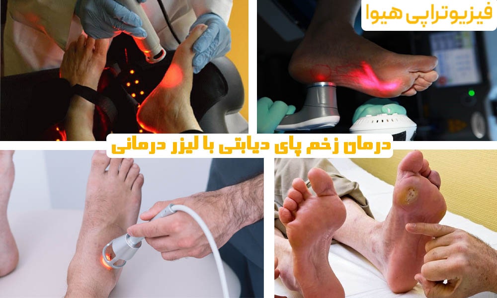 درمان زخم پای دیابتی با لیزر درمانی