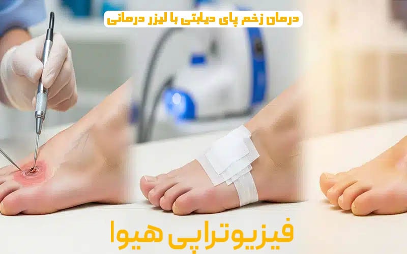 درمان زخم پای دیابتی با لیزر درمانی