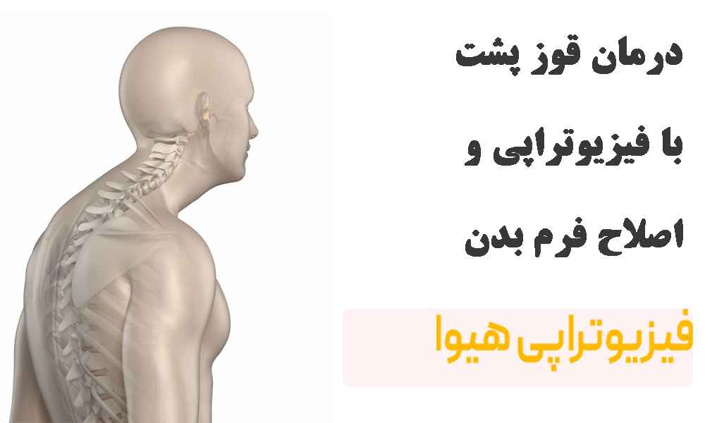 درمان قوز پشت با فیزیوتراپی و اصلاح فرم بدن