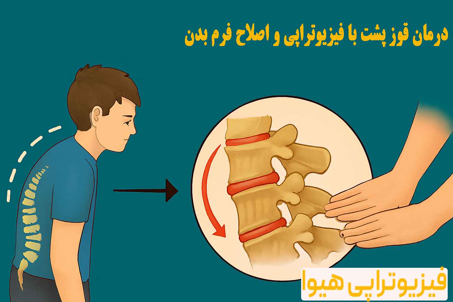 درمان قوز پشت با فیزیوتراپی
