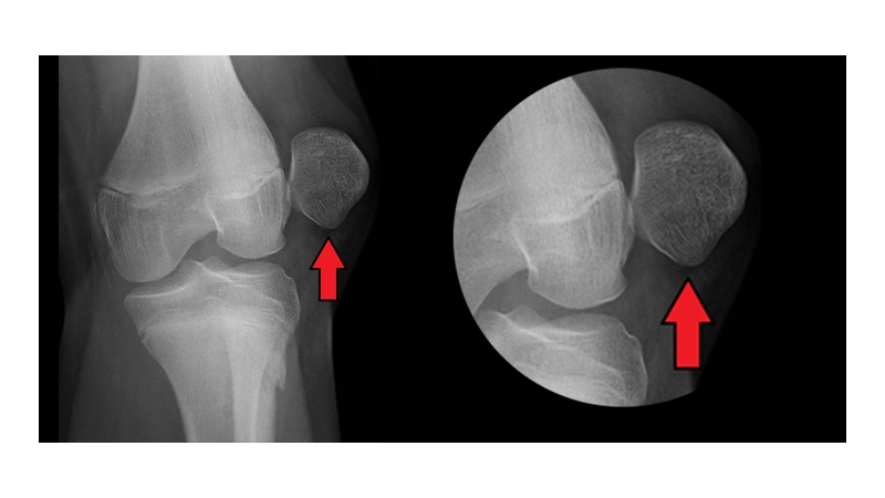 دررفتگی مادرزادی کشکک