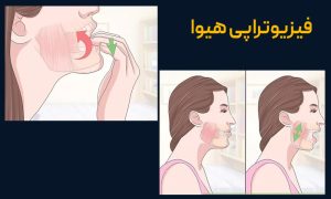 قفل شدن فک یا تریسموس چیست؟