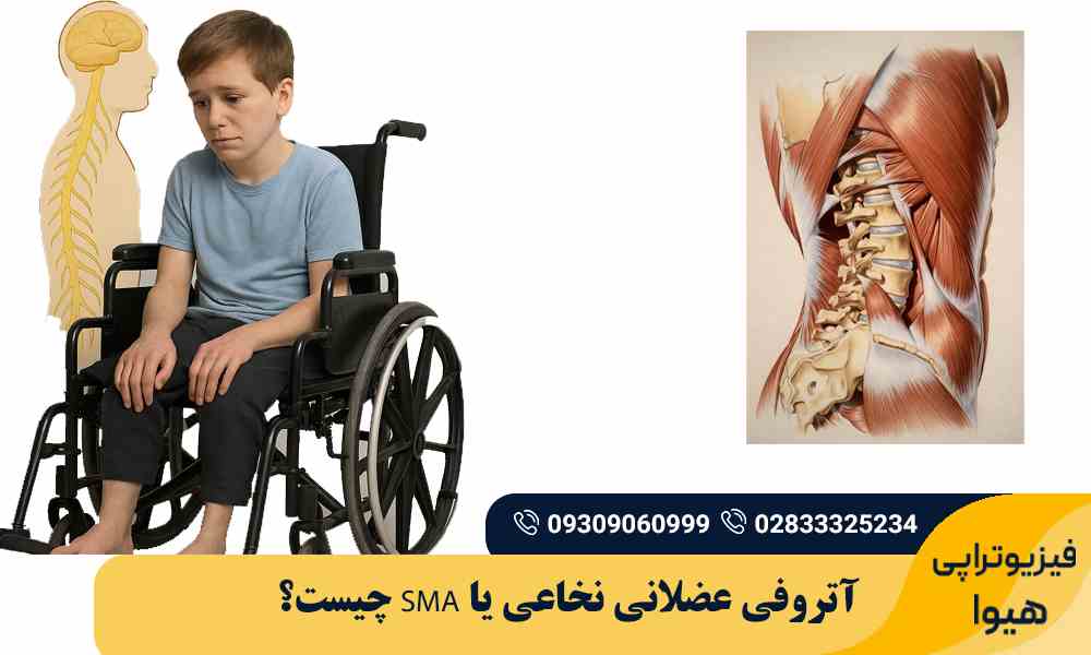 آتروفی عضلانی نخاعی