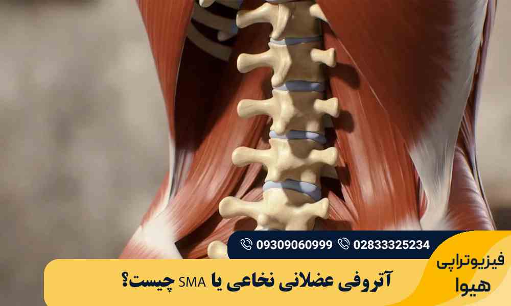 آتروفی عضلانی نخاعی