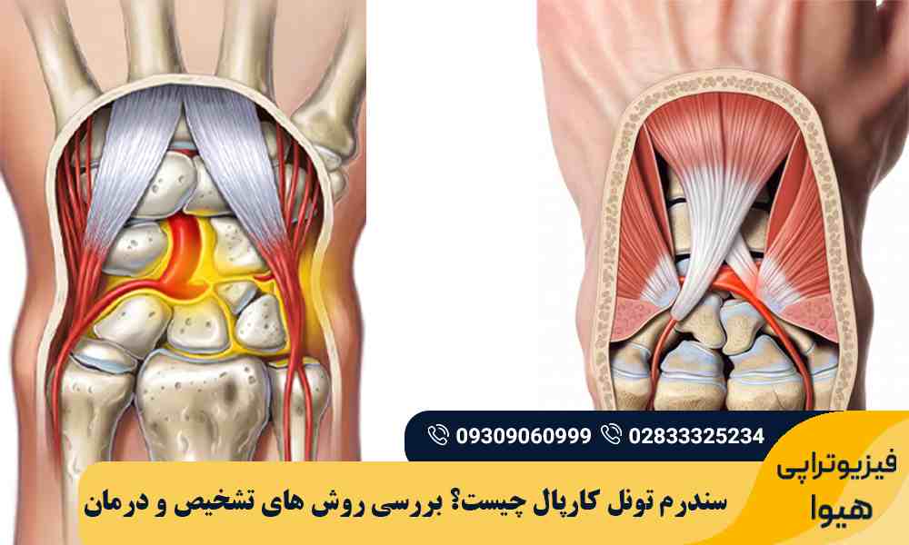 سندرم تونل کارپال