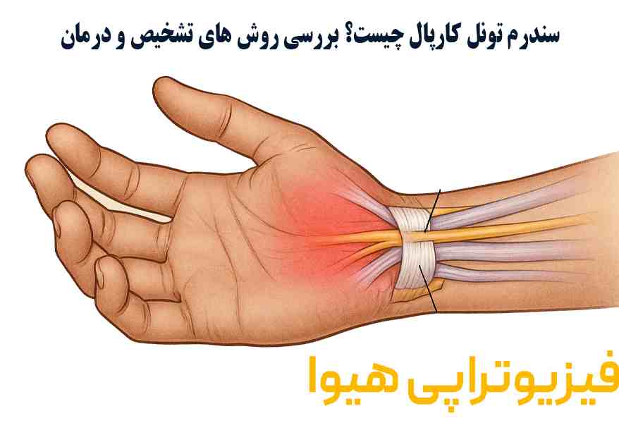سندرم تونل کارپال