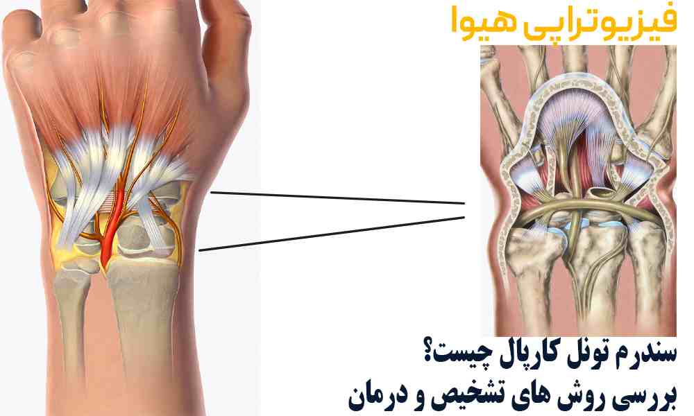 سندرم تونل کارپال