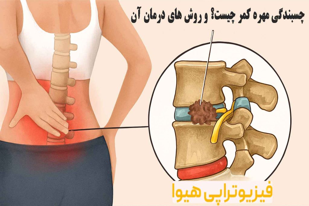 چسبندگی مهره کمر