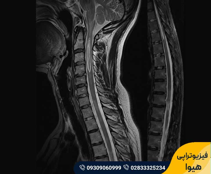 اختلال سیرنگومیلی