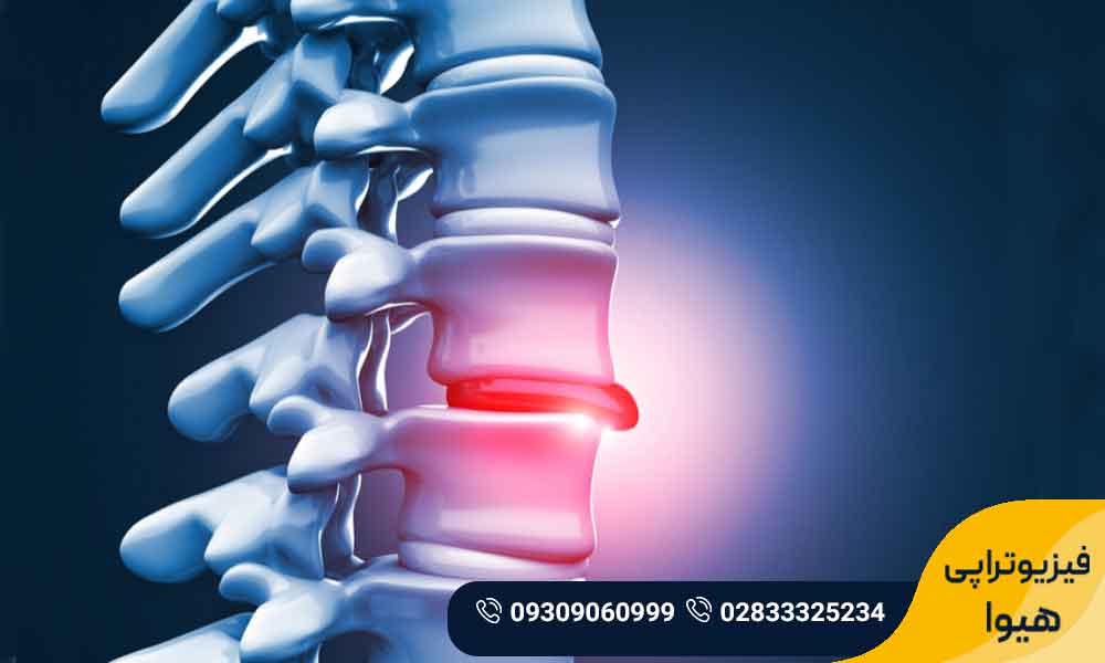 علائم دیسک کمر