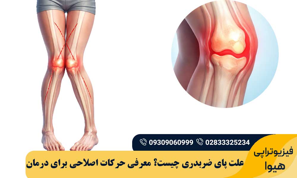 علت پای ضربدری