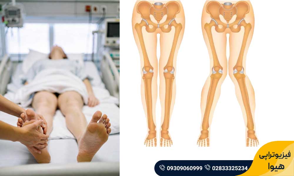 علت پای ضربدری 