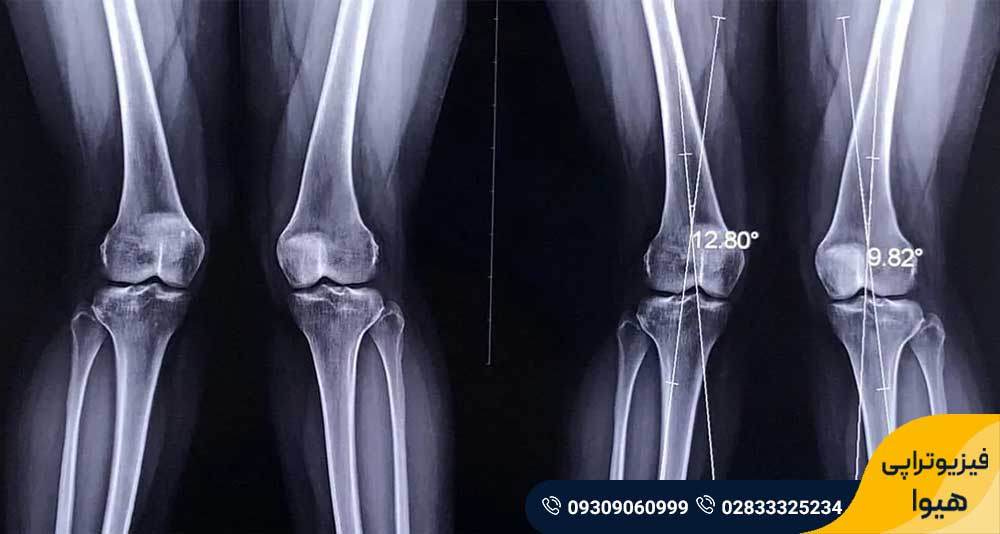 علت پای ضربدری 