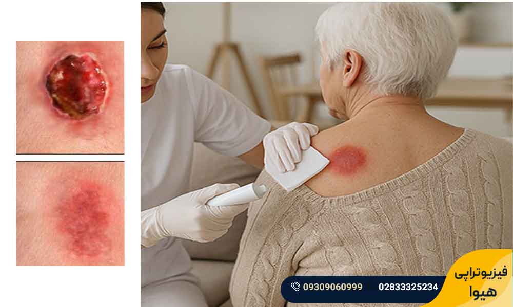 فیزیوتراپی مراقبت از زخم