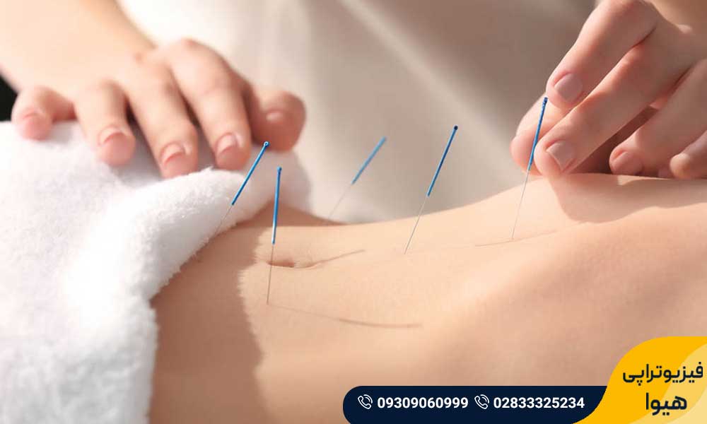 سوزن خشک یا درای نیدلینگ