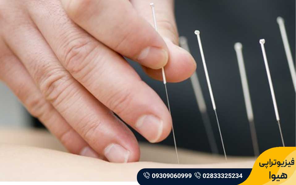 درای نیدلینگ یا سوزن خشک