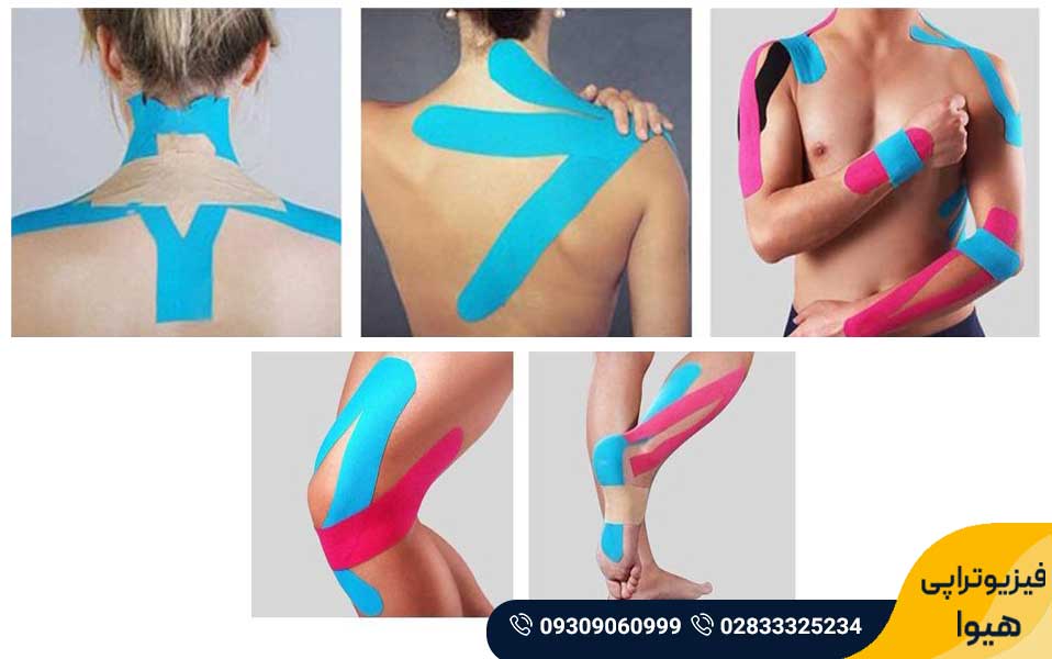 چسب رنگی فیزیوتراپی