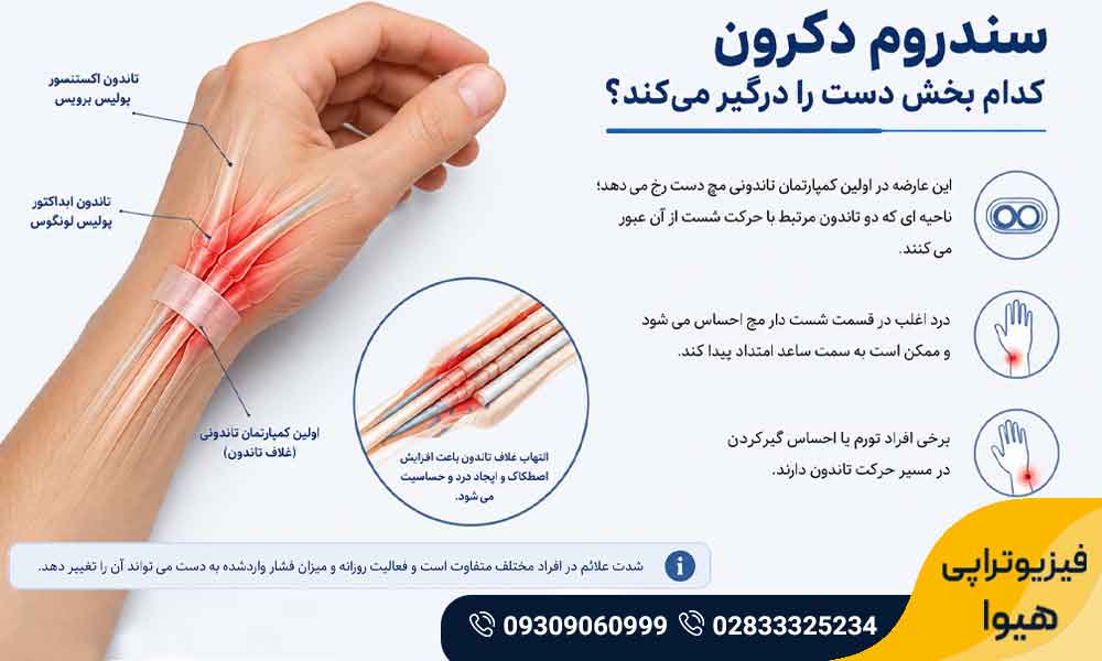 سندروم دکرون