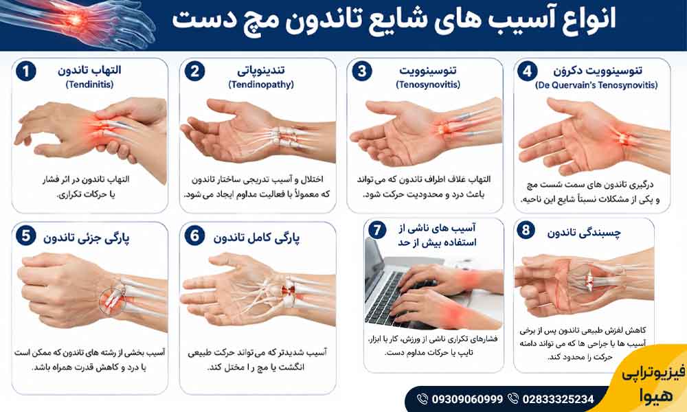فیزیوتراپی تاندون مچ دست